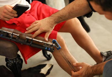 Limb Lengthening in India