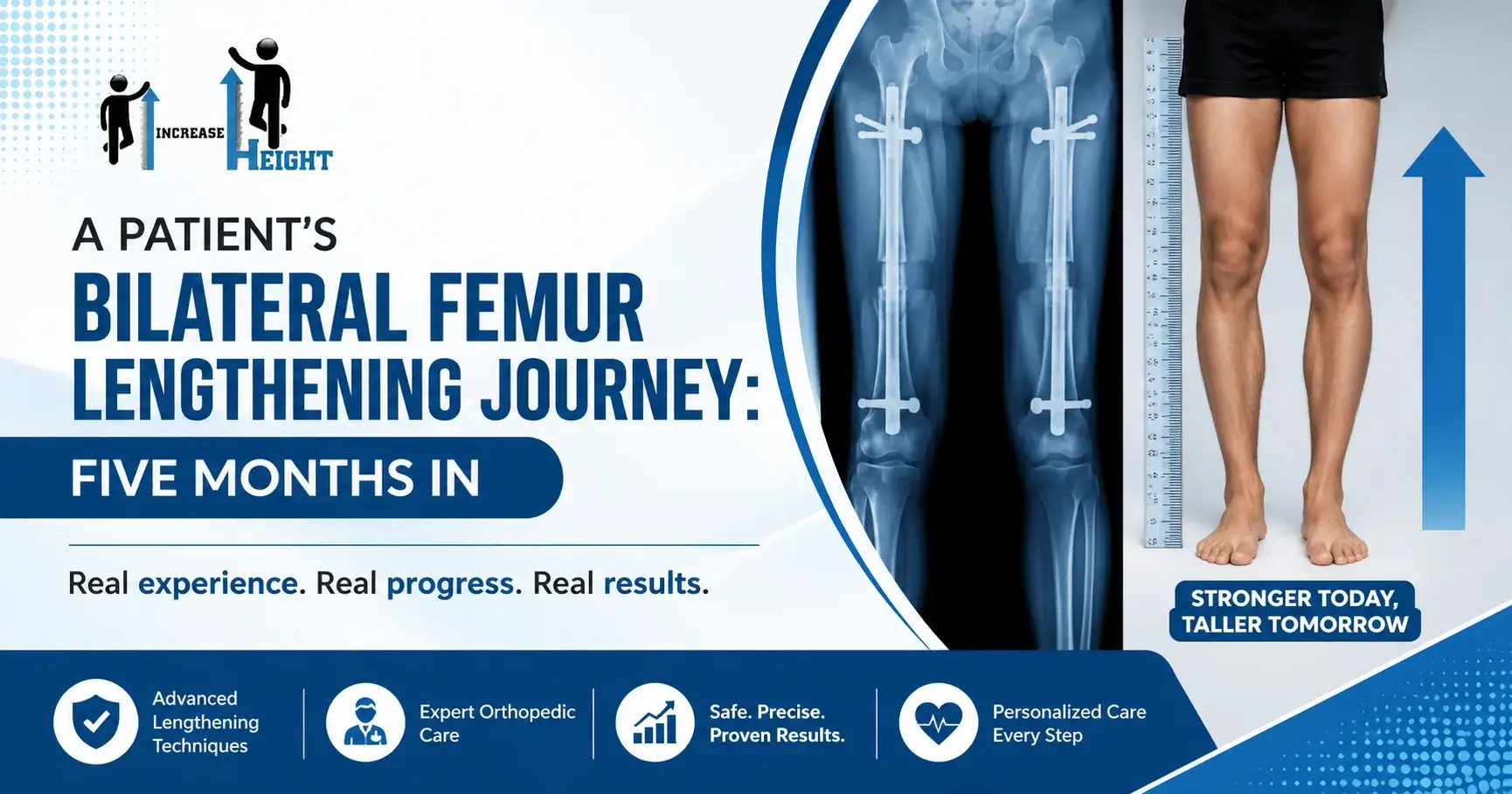 Bilateral Femur Lengthening Journey 5 months later