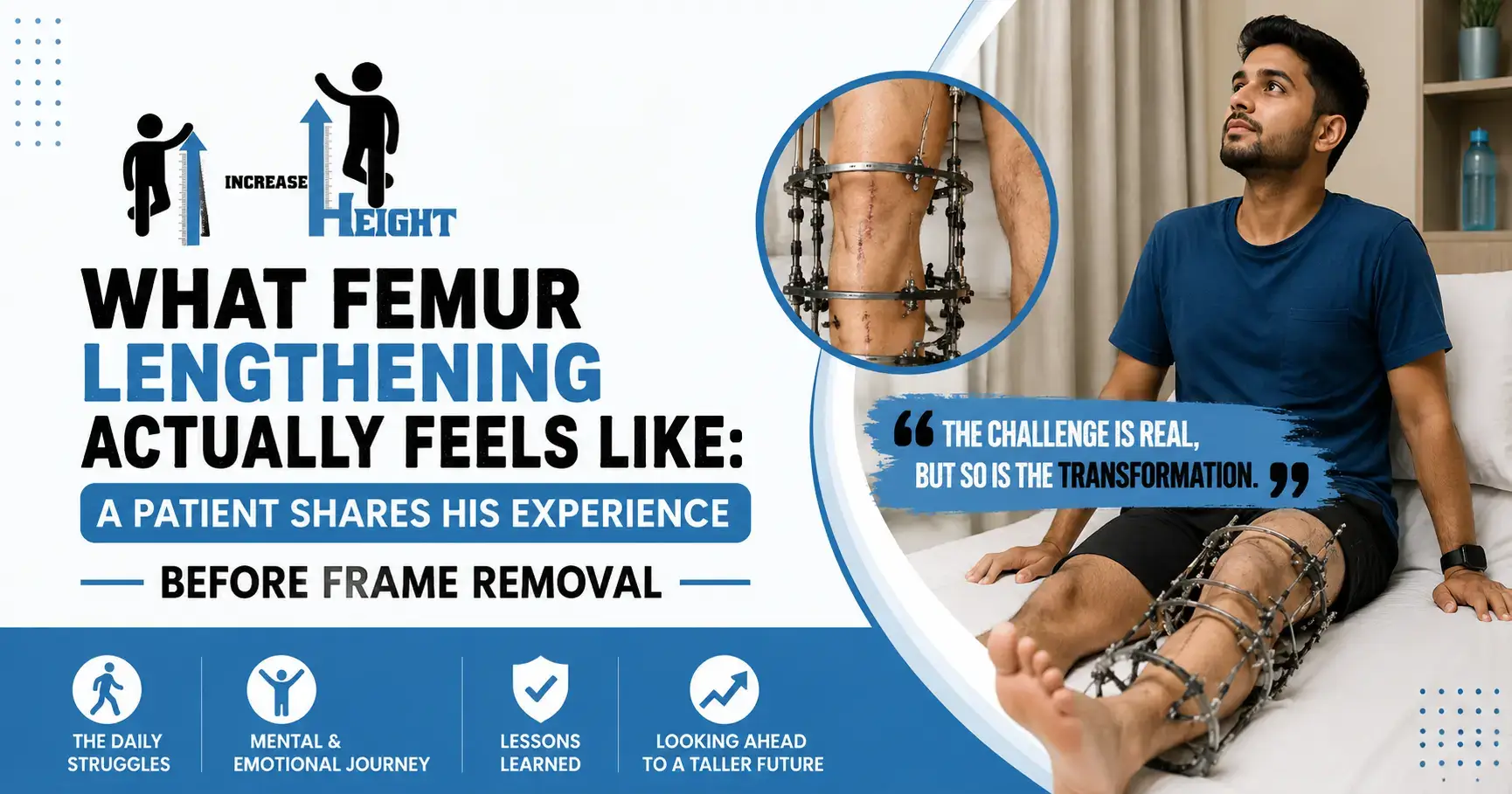 Femur Lengthening Before Frame Removal