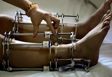 Limb Lengthening in India