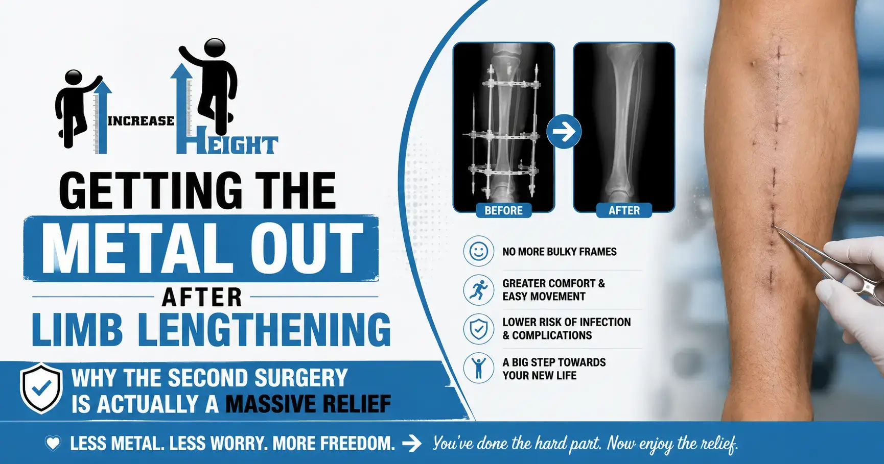 Metal Removal After Limb Lengthening